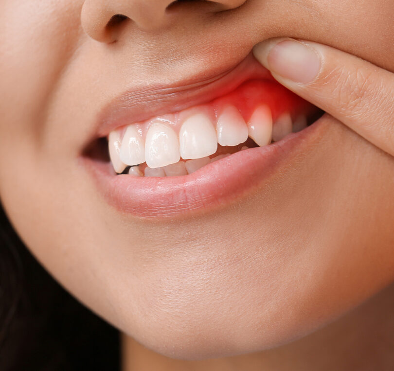 my gums are bleeding