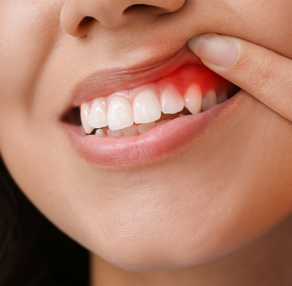 my gums are bleeding