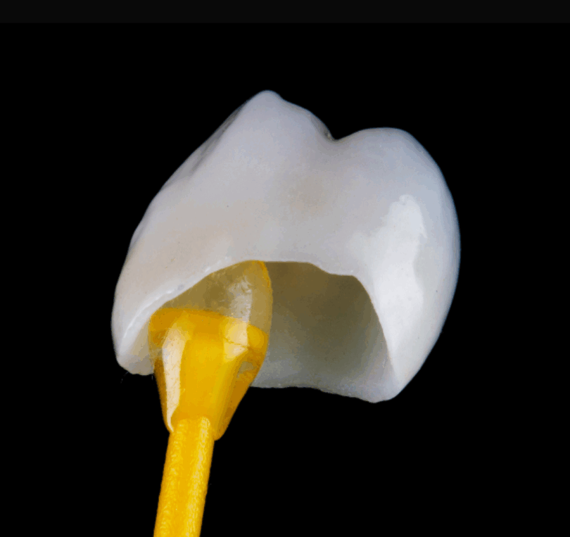 one of the dental crowns ready to be stuck in