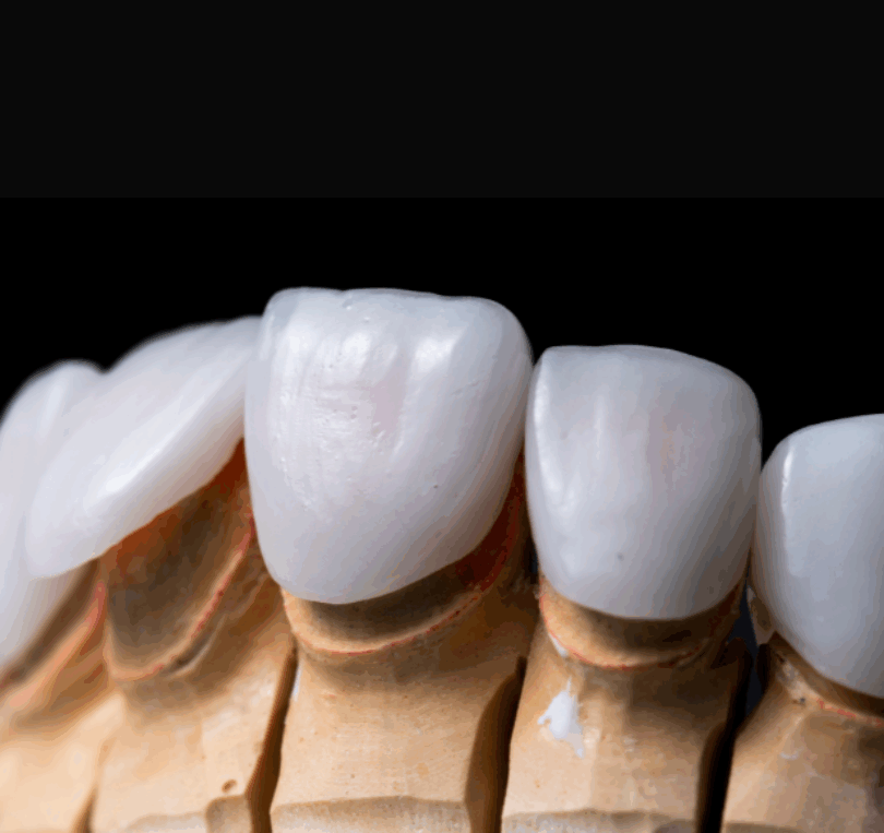 veneers in newbury visual