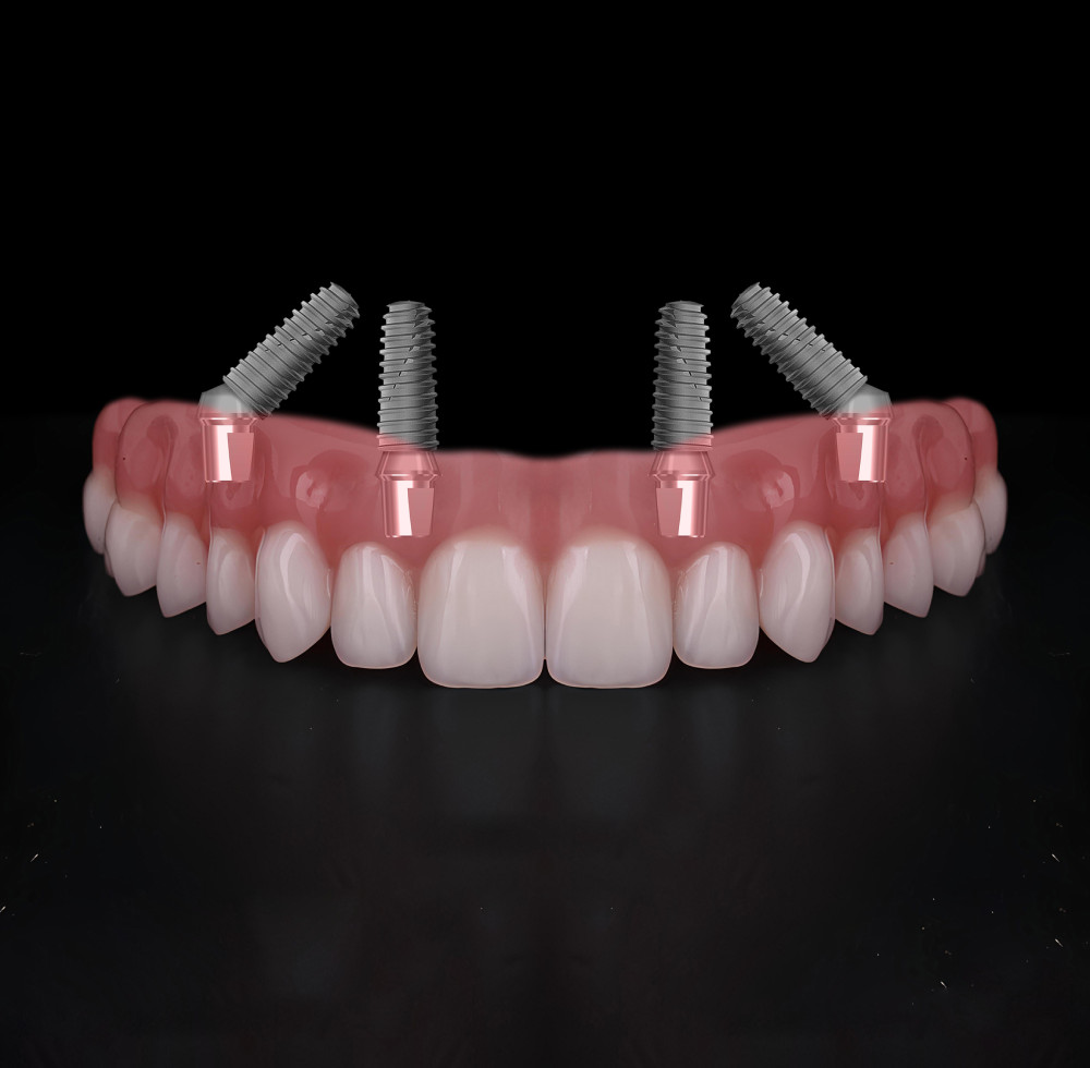 am i suitable for all on four dental implants
