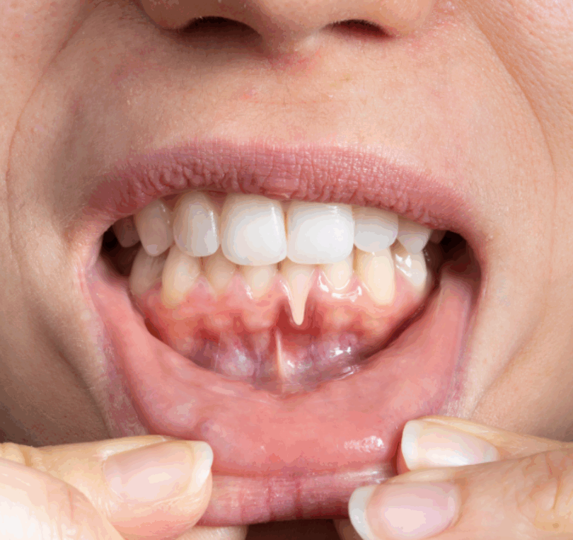 bleeding gums and recession